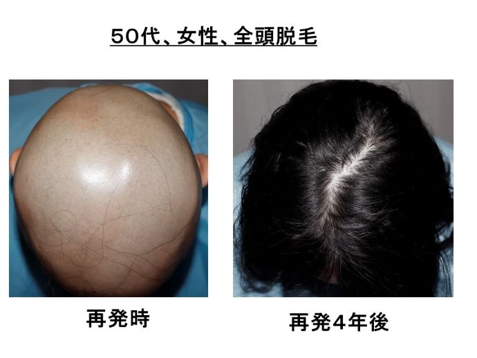 円形脱毛症　病院